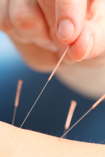 acupuncture